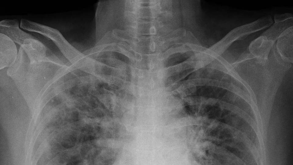 chest xray